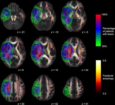 Contralesional White Matter Alterations in Patients After Hemispherotomy